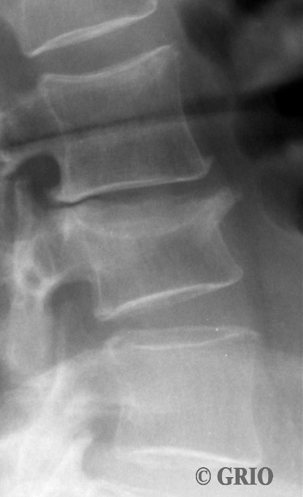 Fracture vertébrale, rachis lombaire (fracture-tassement)