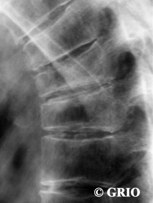 Fractures vertébrales étagées du rachis dorsal